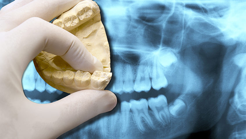 Zahnmedizin Heilbronn | Röntgenaufnahme und Gebissabdruck